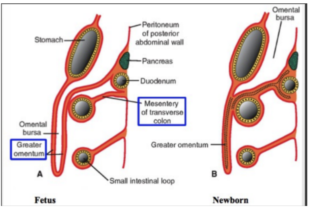 <p>Subdivided into greater sac &amp; lesser sac (omental bursa)</p><ul><li><p>Greater sac —</p><ul><li><p>Accounts for most of the space — begins superiorly at diaphragm &amp; continues inferiorly into pelvis cavity</p></li><li><p>Entered by penetrating parietal peritoneaum</p></li></ul></li><li><p>Omental bursa (lesser sac) —</p><ul><li><p>Smaller subdivision of the cavity, posterior to stomach &amp; liver</p></li></ul><p></p></li><li><p>The two are continuous via the omental foramen/foramen of winslow</p><ul><li><p>This foramen is surrounded by numerous structures covered by peritoneum — </p><ul><li><p>Portal vein, hepatic artery proper, &amp; bile duct anteriorly</p></li><li><p>Inferior vena cava posteriorly</p></li><li><p>Caudate lobe of liver superiorly</p></li><li><p>First part of duodenum inferiorly</p></li></ul></li></ul></li><li><p>Peritoneal cavity can also be divided into a supramesocolic &amp; inframesocolic region based on the transverse colon </p></li></ul>