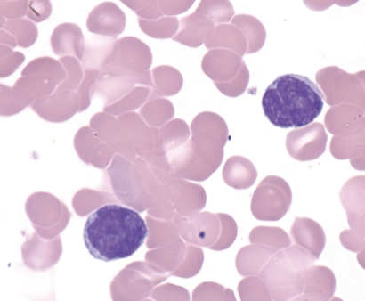 <p>which mature lymphoid neoplasm is associated with the following characteristics:</p><ul><li><p>peripheral blood involvement in 10% cases</p><ul><li><p>circulating cells have a condense chromatin pattern with distinct nuclear clefts</p></li></ul></li><li><p>BM may be involved</p></li></ul><p></p>