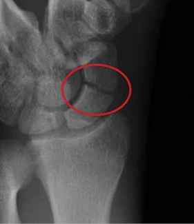 <p>most commonly fracture carpal bone, typically by <strong>falling on an outstretched hand </strong></p>