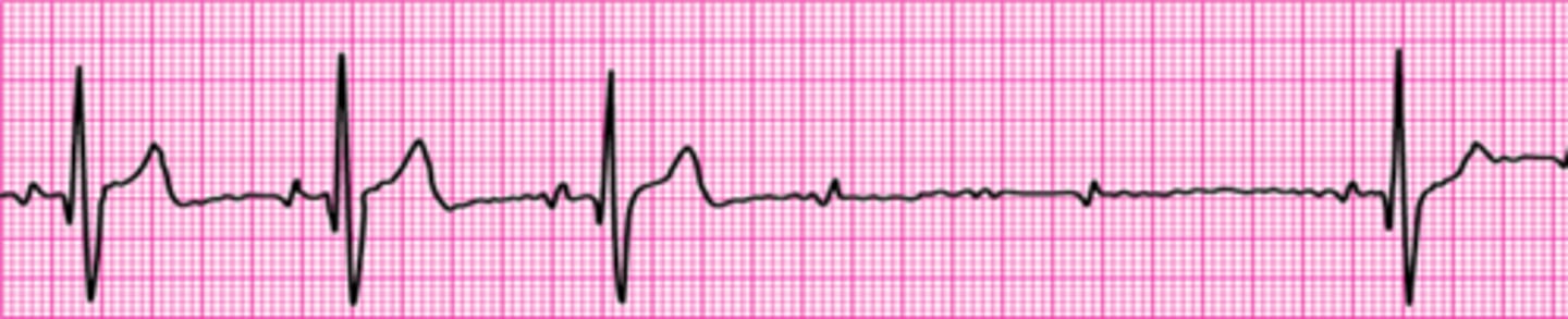 <p>Second-degree atrioventricular block (Mobitz II block)</p>