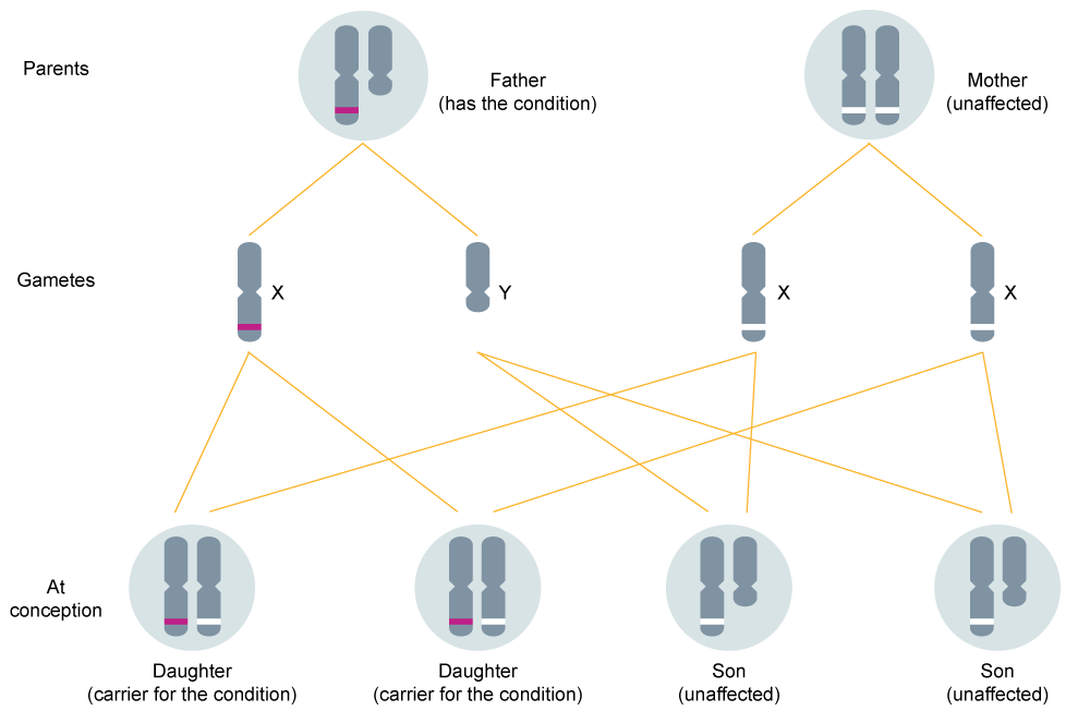 <p>Genes that lie on the X chromosome. These have distinctive inheritance patterns because they are present in different numbers within males and because these genes are nearly 100% linked to the X chromosome since sex chromosomes rarely undergo crossover during prophase 1. These genes, by definition, must also not lie on the Y chromosome.</p><p>Hemophilia is an example of a condition/disorder controlled by these genes. Given that a mother carrier and an unaffected father breed together, males have a 50% chance of getting hemophilia (It is given that the father gives Y and the mother will either give a recessive X gene or a dominant one) however females have a 0% chance of getting it due to the fact that the father will donate a dominant allele, thus leaving them only with the ability to be carriers if they receive the recessive allele from the mother or the ability to be clean if they receive the dominant allele.</p><p>The picture attached outlines a diagram for the case that an affected father breeds with a clean mother.</p>