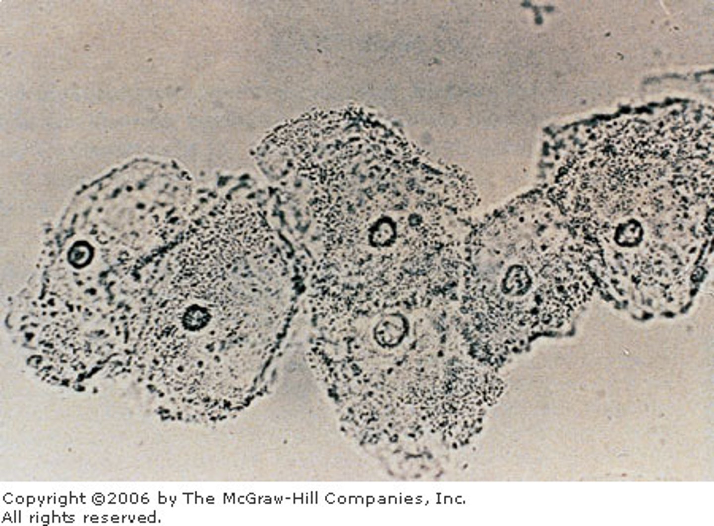 <p>Are a variation of squamous epithelial cells that ARE of clinical significance</p><p>- They are indicative of a vaginal infection from Gardnerella vaginalis</p><p>- They appear as squamous cells covered with the Gardnerella coccobacillus bacteria. This gives the cell a granular/irregular appearance</p>