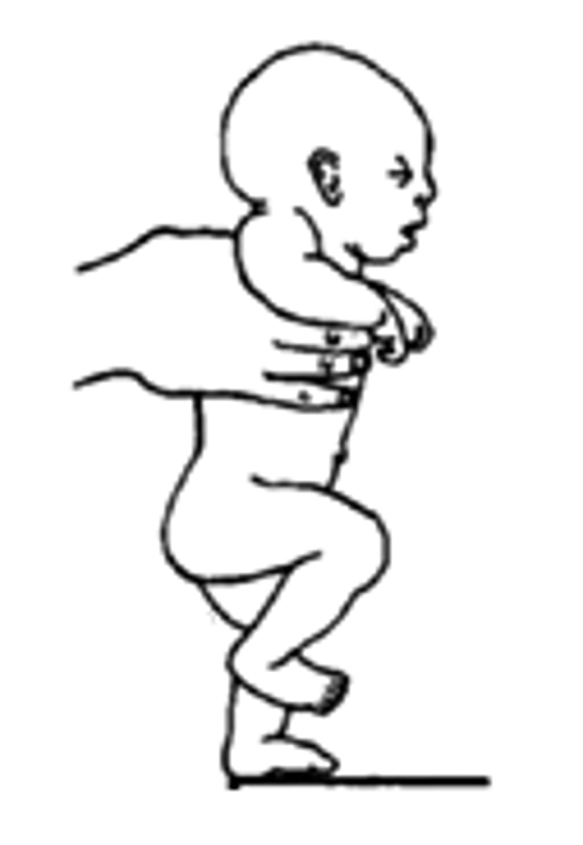 <p>a neonatal reflex in which an infant lifts first one leg and then the other in a coordinated pattern like walking</p>