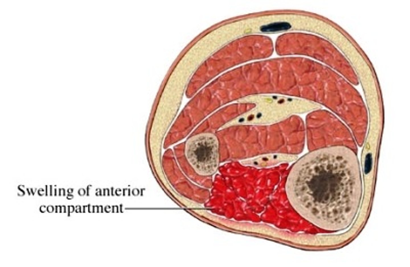 <p>MOST COMMON IN ANTERIOR COMPARTMENT OF LEG</p><p>Increased pressure within a closed fascial compartment - compromises circulation and tissue perfusion</p>