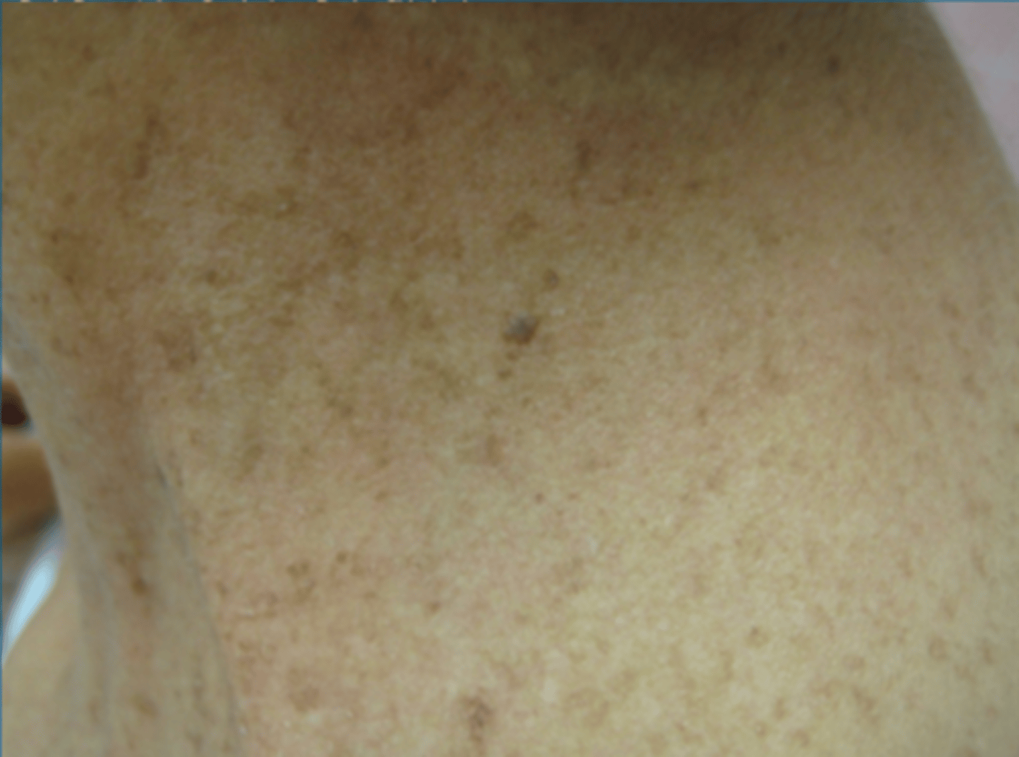 <p>What are the cosmetic treatments available for solar lentigines?</p>