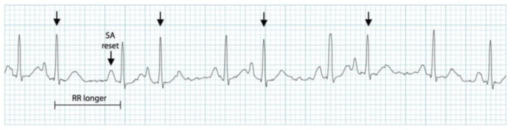 <p>what rhythm is shown in the ECG?</p>