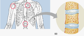 cartiliginous joint: pubic symphysis, intervertebral discs; hyaline cartilage on ends of bones connected to fibrocartilage in the middle.  (slightly movable)
