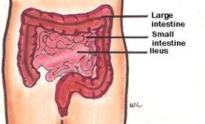 <p>Failure of bowel peristalsis</p>
