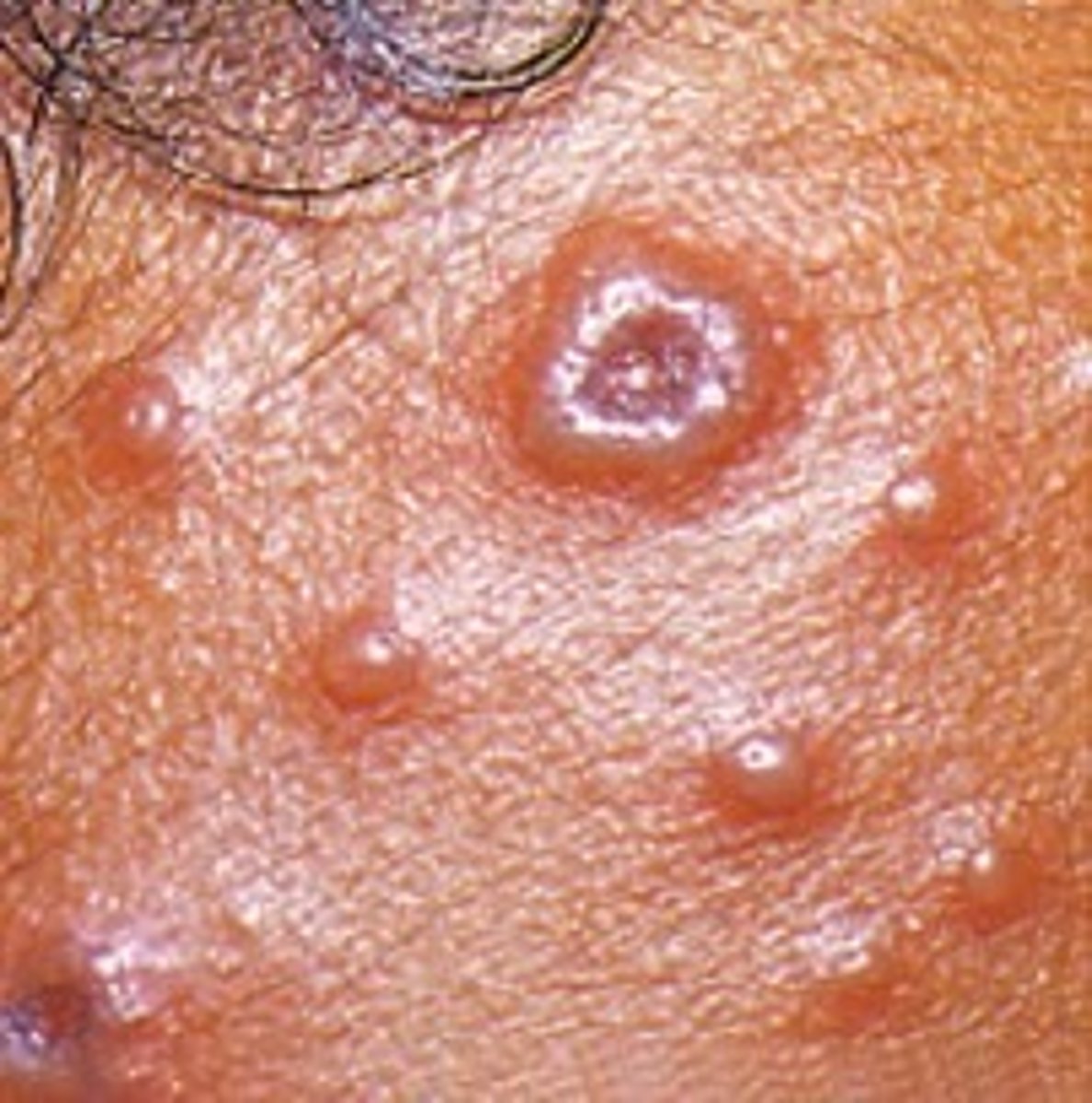<p>-Loss of a part of the epidermis, depression</p><p>-Moist and glistening</p><p>Examples:</p><p>-Cavity in the skin due to acne</p>