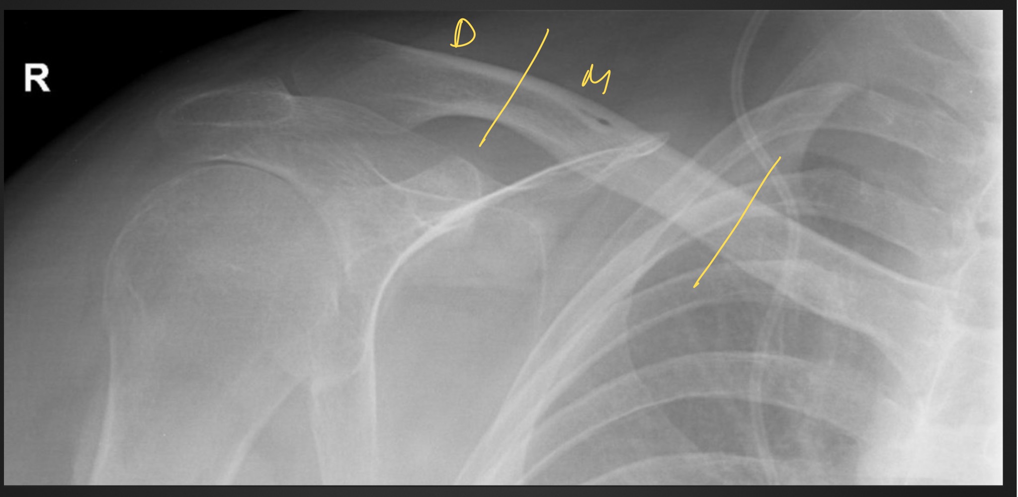 <p>what is this anomaly called </p>