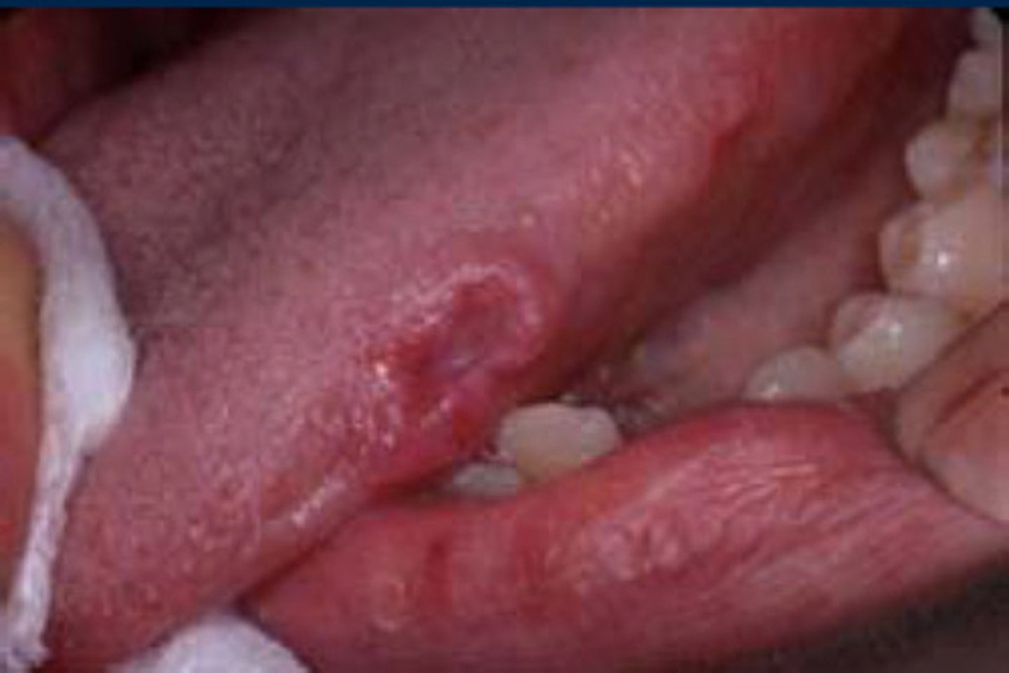 <p>Cheek, lip, or tongue biting; Denture irritation; Mucosal injury; Overzealous brushing; Usually heals within 7-14 days unless the trauma persists; May require a biopsy</p>