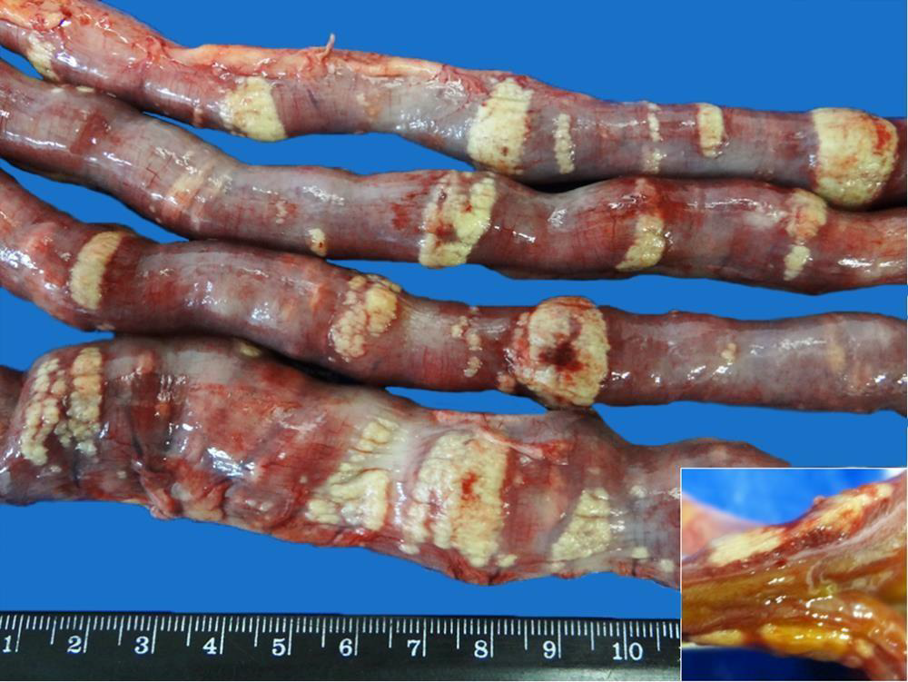 <ol><li><p>Hyperparathryroidism</p></li><li><p>Vit D intoxication</p></li><li><p>Uremia</p></li></ol><p></p>
