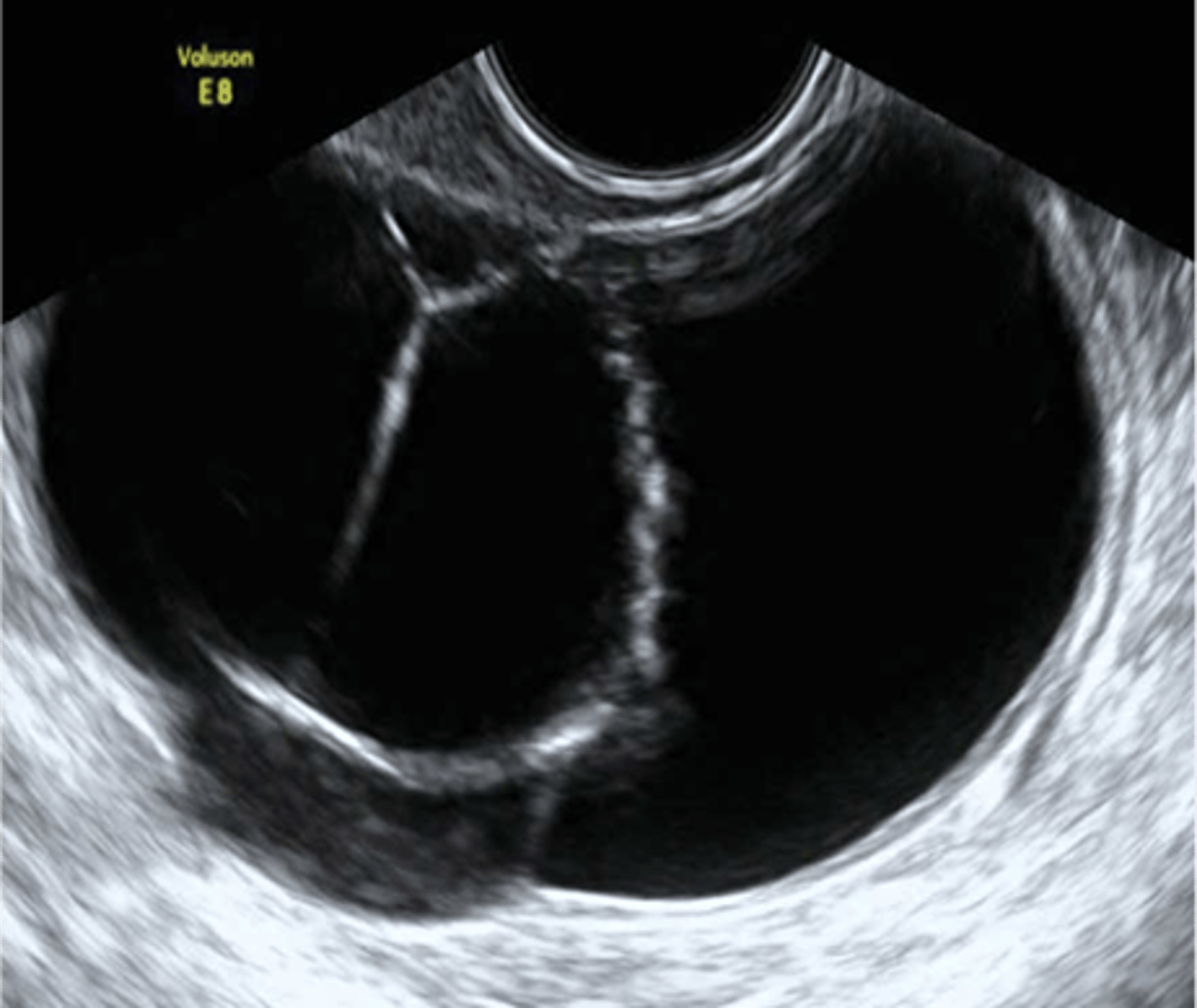 <p>pregnancy</p>