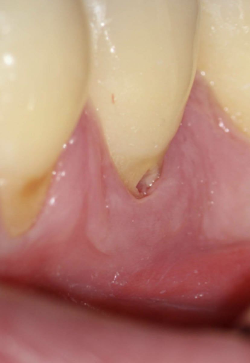 <p>What treatment is indicated?</p>