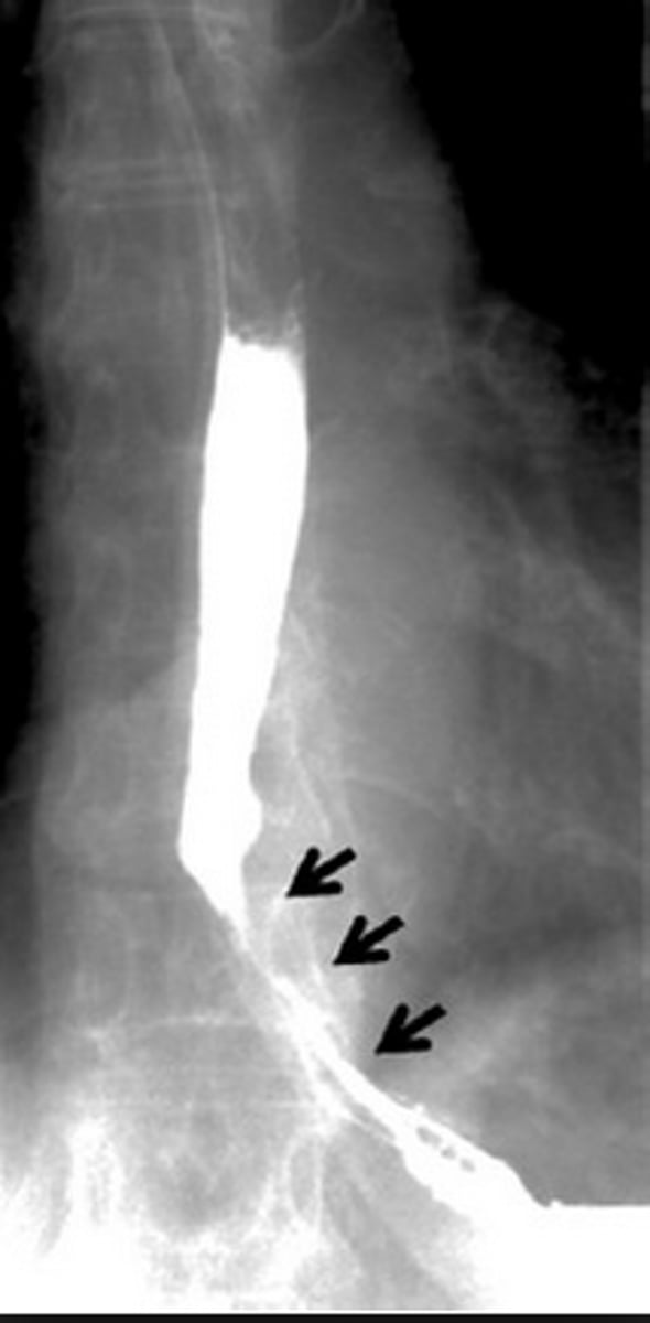 <p>narrowing of the esophagus</p><p>superior- scarring from suicide attempts, lye or corrosive material swallowed, smooth appearance</p><p>middle and inferior- scarring from GERD, neoplasm</p>