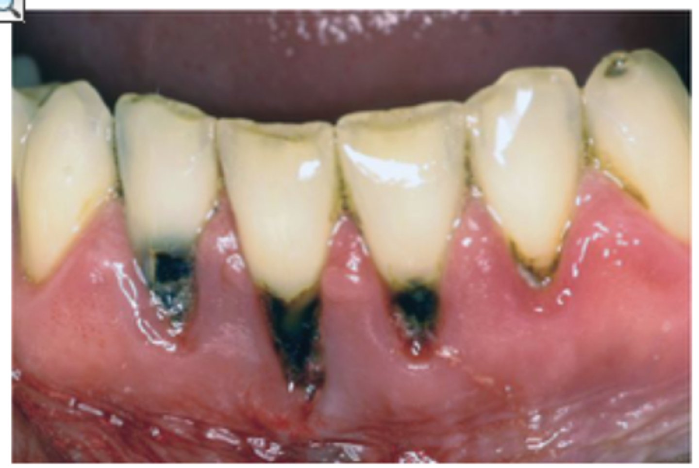 <p>it measures root caries only. It includes only root surfaces that are at risk and is reported as a % of decayed and filled root surfaces</p>