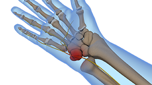 <p><span>-Ulnar nerve compression at wrist</span><br><span>-repetitive motion, pressure, fascial thickening</span><br><span>-positive tinel's </span><br><br><span>Conservative tx (wrist splint in neutral)</span><br><br><span>Post op tx (edema, AROM, nerve glides, strengthening 2-4wk)</span></p>