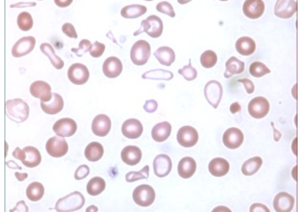 <p>A patient is admitted to the emergency room with severe lethargy, glossitis, and muscle dysfunction. After the physician orders a complete blood count with differential, the hematology technologist observes cells matching the image to the right. </p><p>Which condition is most consistent with the clinical and laboratory findings?</p>