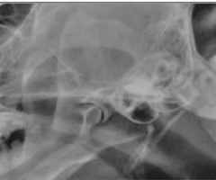 <p><span><span>What is best viewed by a lateral oblique?</span></span></p>