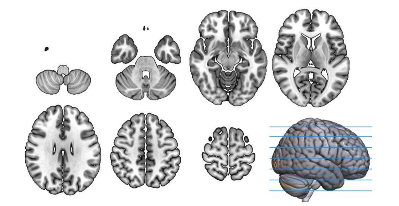 <p>splits brain into top and bottom, parallel to the floor, useful for birds eye view from below to the top</p>