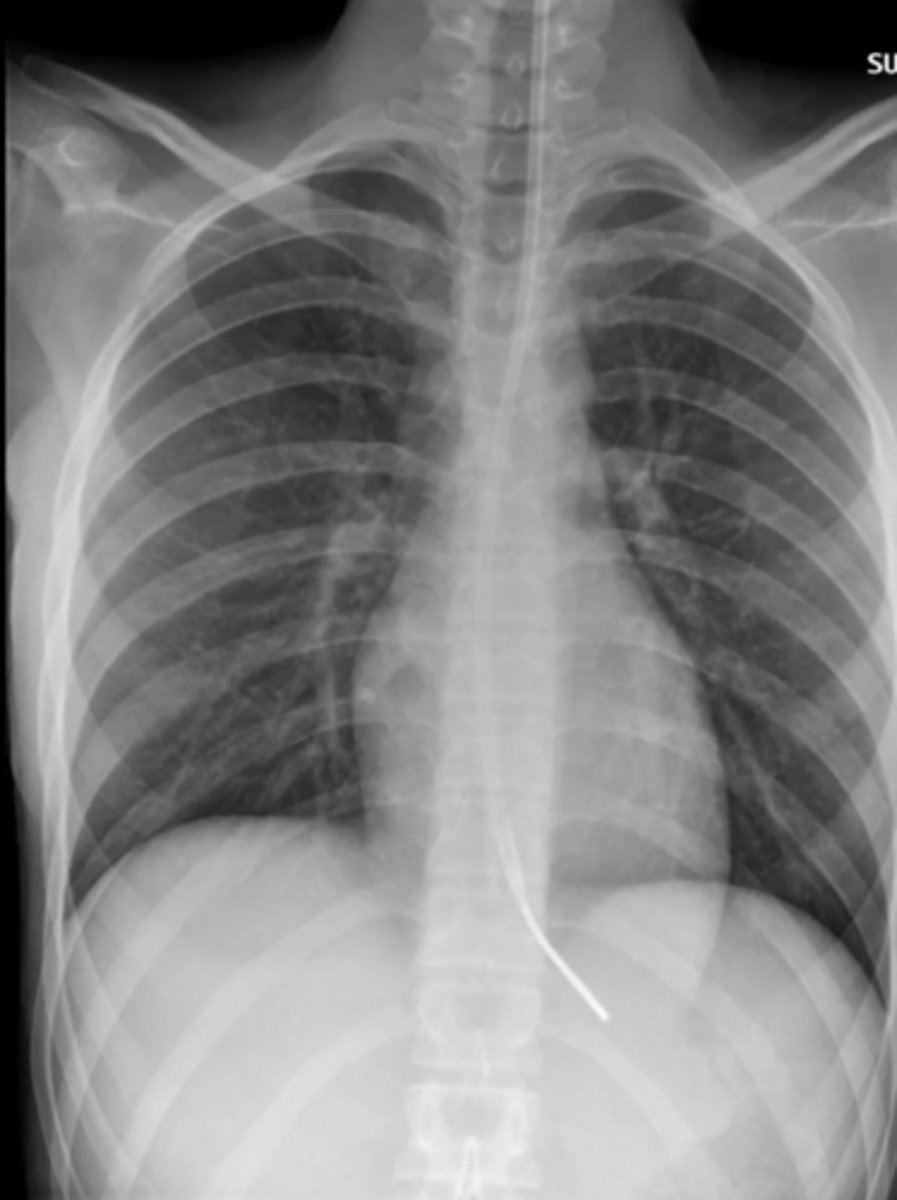 <p>tube inserted through nose and into stomach</p>