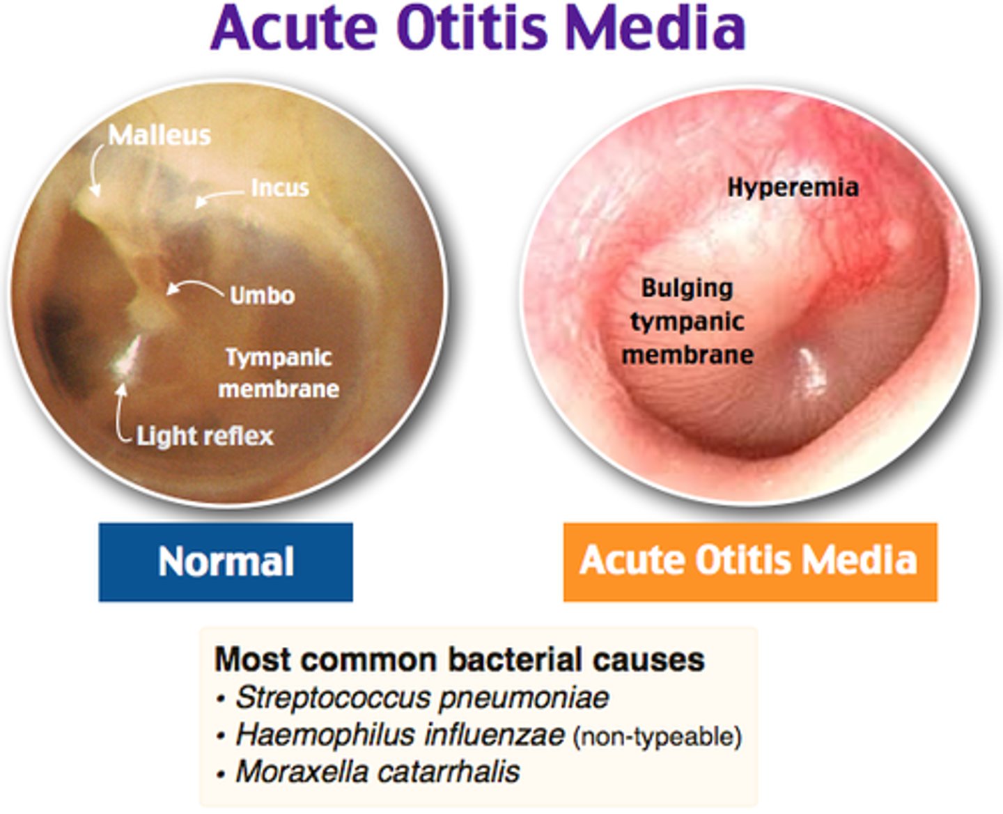 <p>AOM → amox or augmentin</p><p>comps: mastoiditis (MC), bullous myringitis, TM perforation</p>