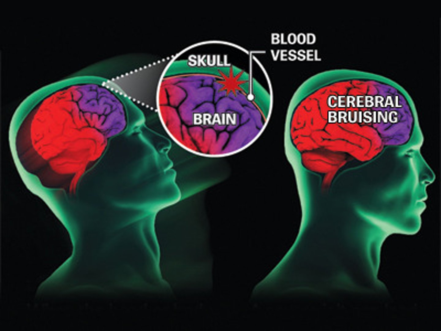 <p>most common type of injury to the brain caused by a blow</p>
