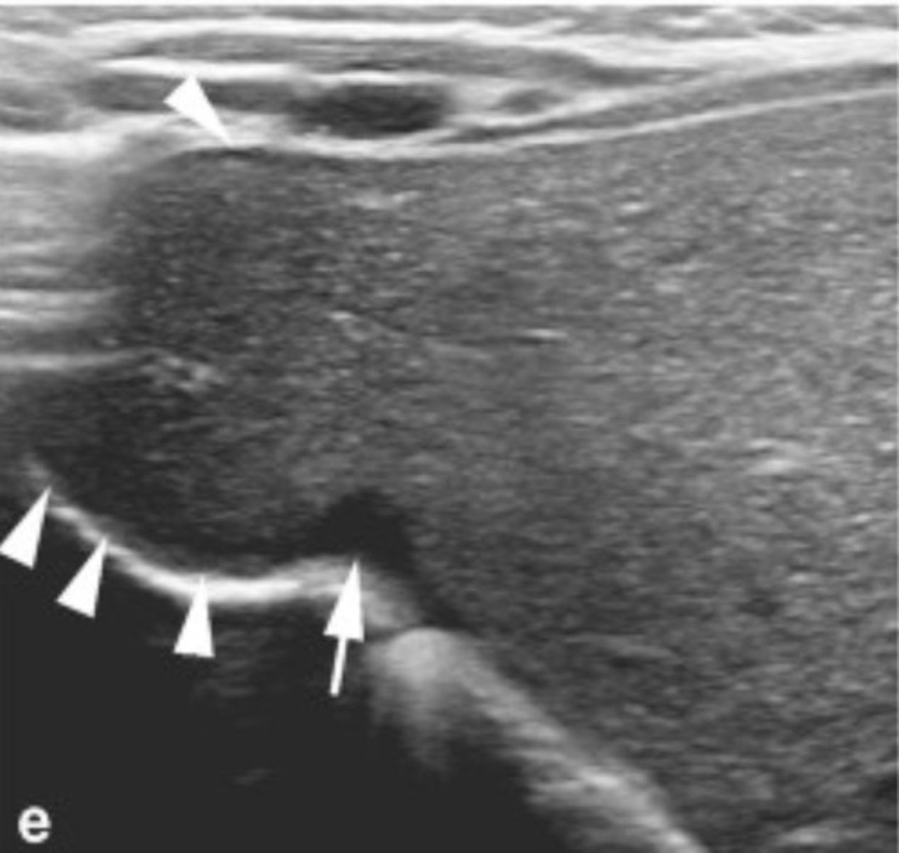 <p>Denting of diaphragm</p><p>Diaphragm does not function properly = breathing issues</p>