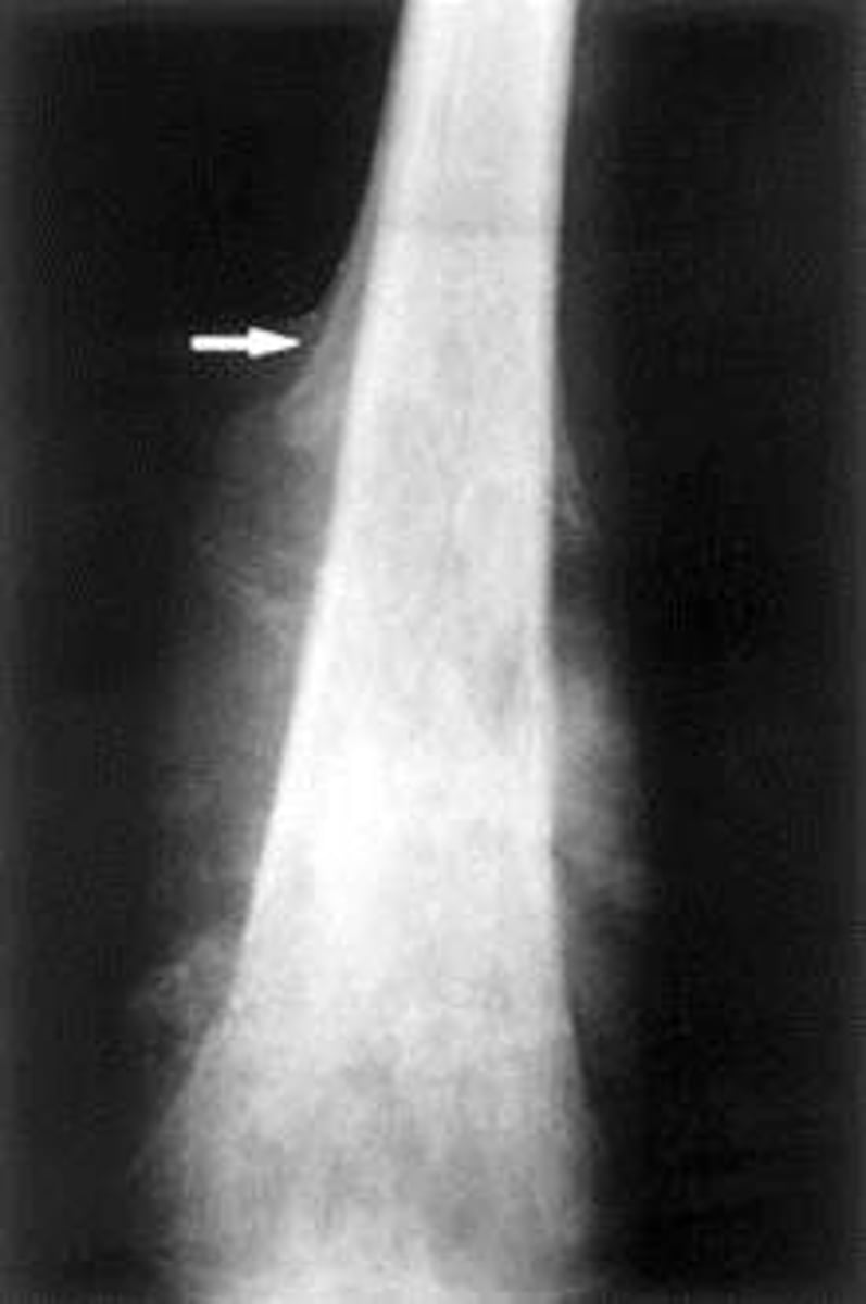 <p>True</p><p>-there may be familial and genetic causes, and they occur near sites of bone growth</p>