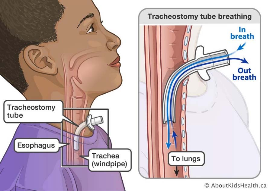 <p>tracheostomy </p>