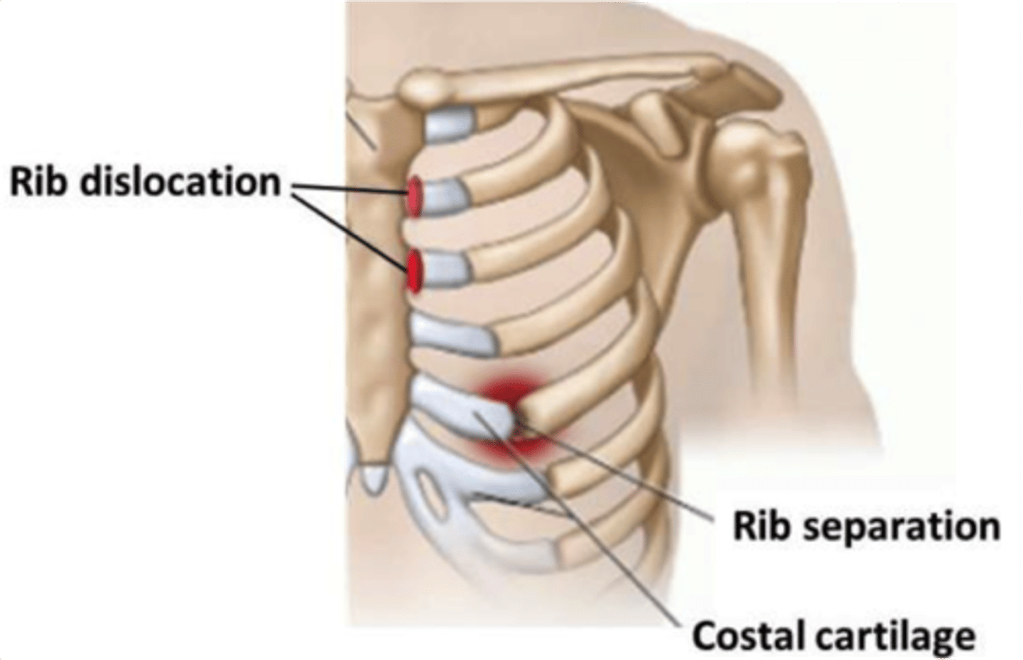 <p>An inflammation of the cartilage that connects the rib to the sternum.</p>