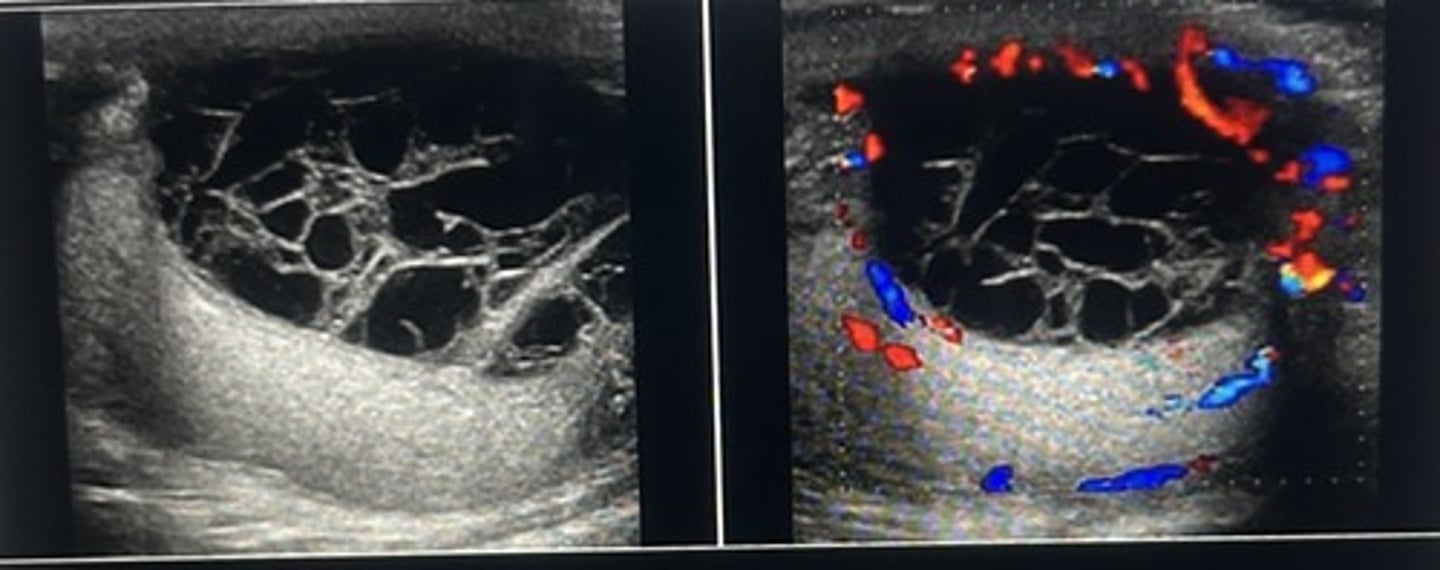 <p>There is a complicated fluid collection compressing the testicle</p>