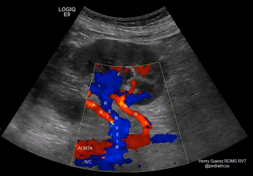 <ul><li><p>There is usually one on either side, though multiples are quite common</p></li><li><p>Occur in 14-25% of the population </p></li><li><p>There can be duplicate, three or more</p></li></ul><p></p>
