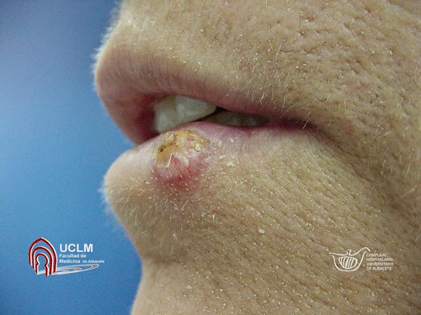 <p>A 68-year-old patient presents with a dome-shaped lesion on the lower lip that developed over the past 4 weeks. The lesion is firm, well-circumscribed, and asymptomatic. What is the MOST likely diagnosis?</p>