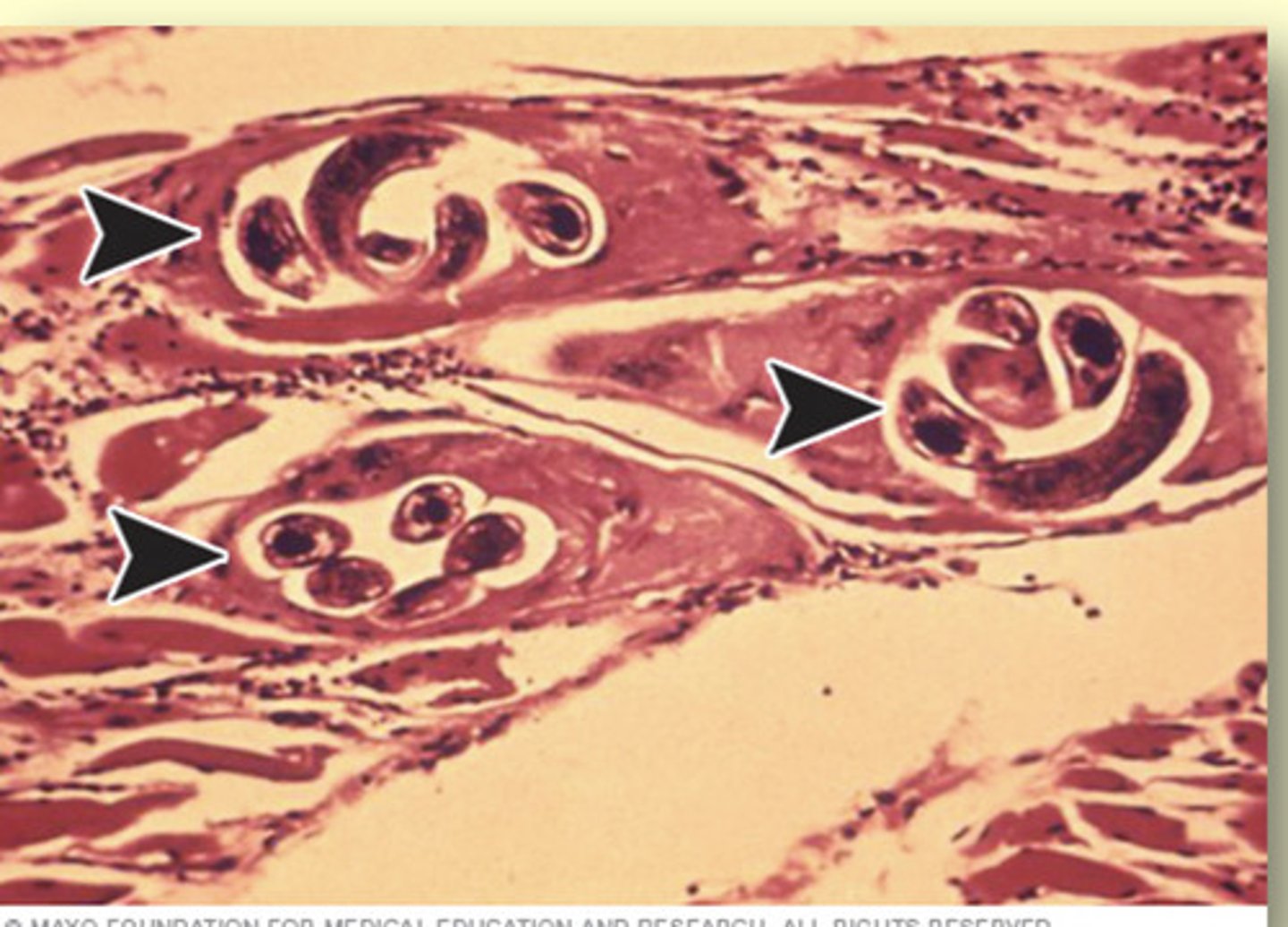 <p>reaction can produce a hard cyst in the muscle or skin that encases the parasite</p><p>----------------</p><p>EXAMPLE:</p><p>- pigs form cysts around roundworms that infect their muscles</p>