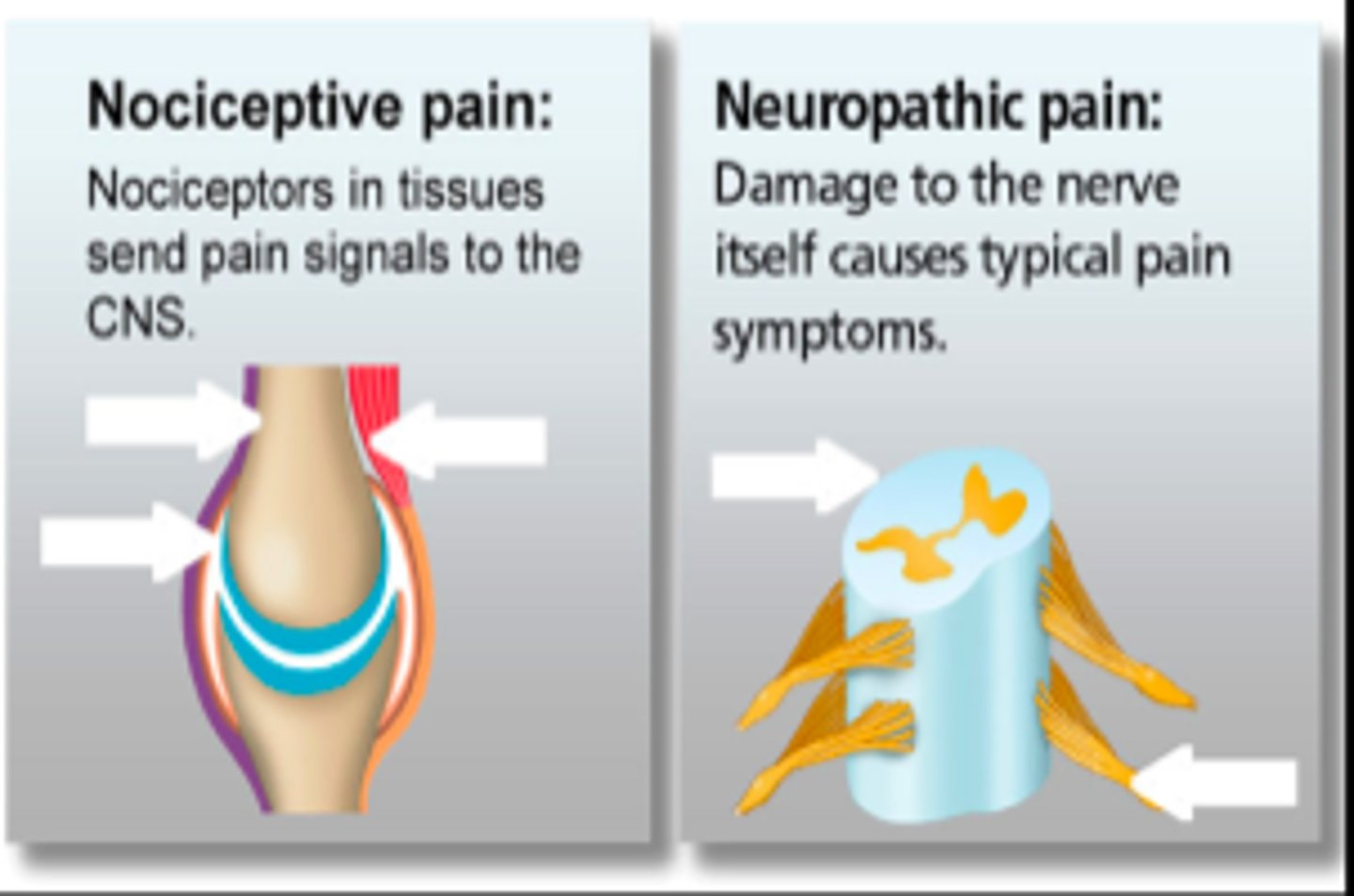 <p>damage to <strong>neurons in the PNS/CNS</strong> themselves = sensitization of these systems<br>- PERIPHERAL SENSITIZATION: increase in stimulation of peripheral nociceptors = amplified pain signals<br>- CENTRAL SENSITIZATION: hyperstimulation of dorsal horn neurons = amplified pain</p><ul><li><p>damage to nerves themselves rather than tissues</p></li></ul>