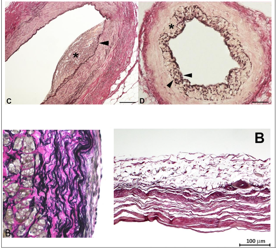 <p><span>Most useful for highlighting elastic fibers in connective tissue. Elastin fibers stain blue-black, collagen fibers stain red, nuclei stain black and cytoplasm turns a background yellow.</span></p><p></p><p><span>Top Image (Left): Coronary artery, arrow head indicates the internal elastic lamina (stained black due to the Stain. Note the red-staining collagen in the tunica adventitia.</span></p><p><span>Top image (Right): Coronary artery with black staining of a fragmented internal elastic lamina. Note the red staining collagen in the tunica adventitia.</span></p><p><span>Bottom Image (Left): Histopath image of an aneurysm wall showing black staining elastin fibers within the tunica media.</span></p><p><span>Bottom Image (Right): Section of myocardium completely replaced by fibrous tissue (staining blue-black) and scattered groups of epicardial adipocytes.</span></p>