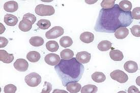 <p>Reactive lymphocytes are indicative of:</p>