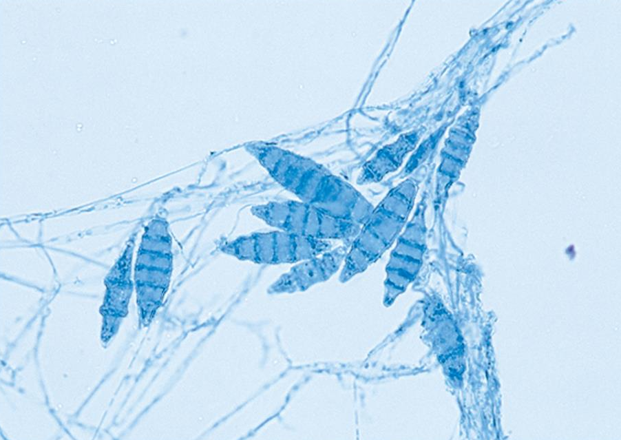 <p>Measure 8 to 15 um and can have as many as 6 cells. Powdery, granular appearance colony surface. Fresh isolates typically form a tan to buff conidial masses, but this species tends to develop pleomorphic tufts of white sterile hyphae in aging cultures and after serial transfers. Abundant brown to red pigment can form beneath some strains. Found in soils worldwide. </p>