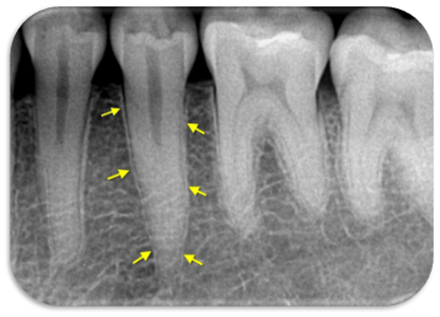 <p>ID the structure:</p><p>A sheet of compact alveolar bone that lies adjacent to the periodontal membrane i.e. lining of the alveolus</p>