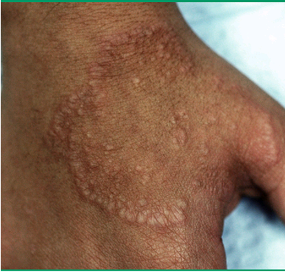 <p>self limiting dermatosis characterized by erythematous or skin colored annular plaques; exact cause unknown</p>