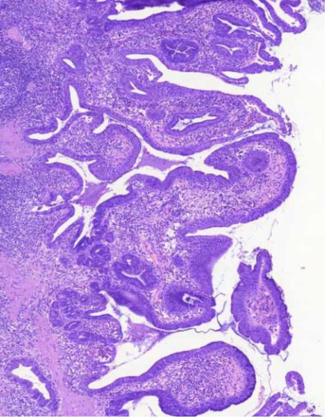 <p><strong><u>MIKÄ TAUTI?</u></strong> Sappirakon seinämä on paksuuntunut ja villusmaiset rakenteet ovat melko epäsäännöllisiä. Seinämässä on runsasta tulehdussolulisää</p>