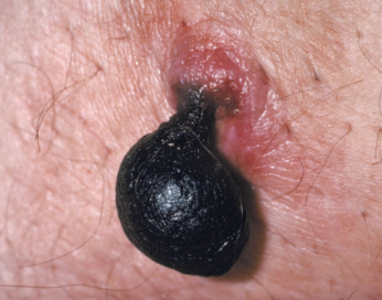 <p>a skin tag that has formed a blood clot, leading to a painful and discolored lesion </p>