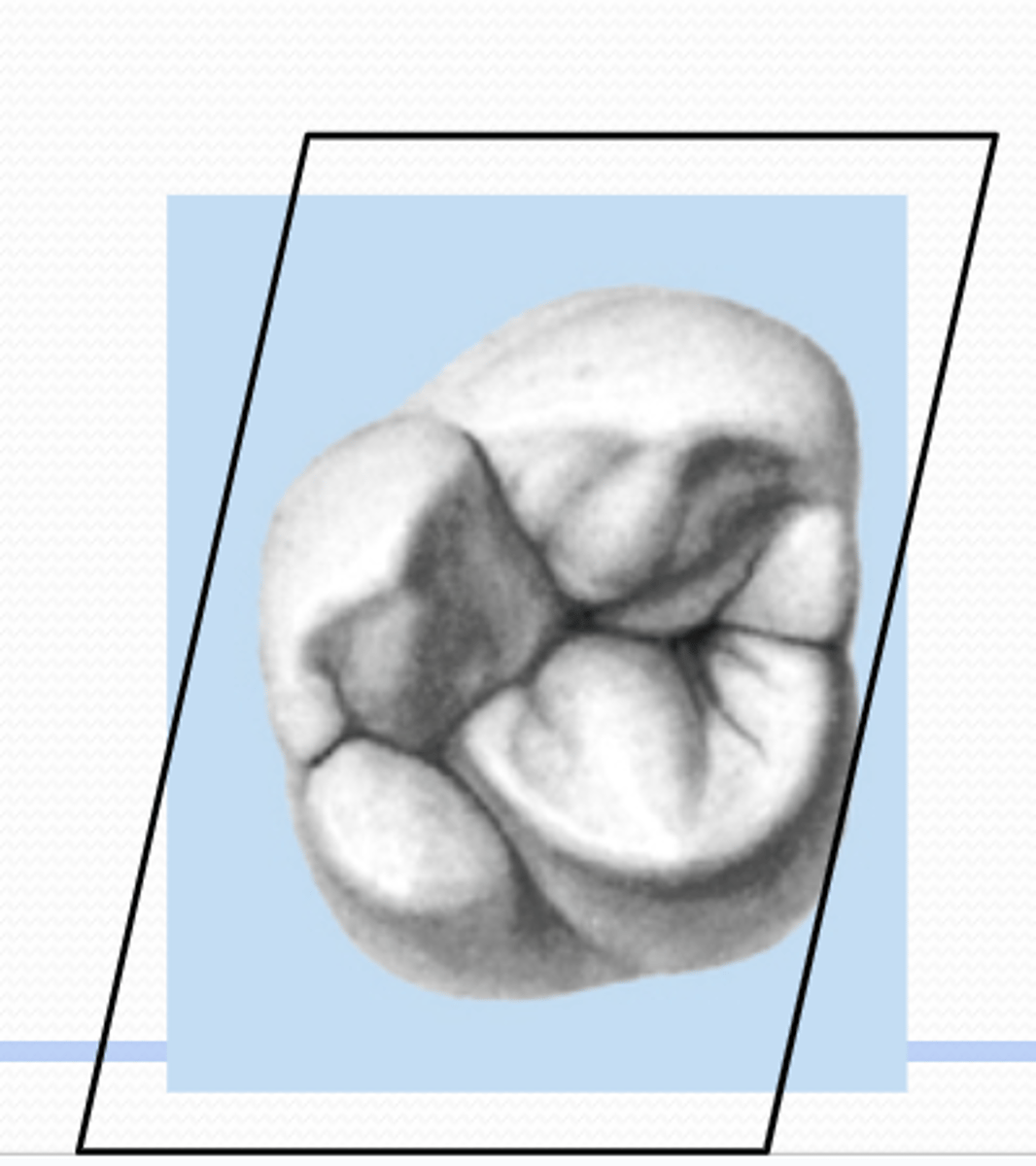 <p>more common and is similar to the mx 1st molars (ML, MB, DB, DL)</p><p>rhomboid shape like Mx 1st molars</p>