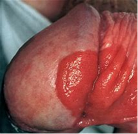 The diagnosis of this lesion is 