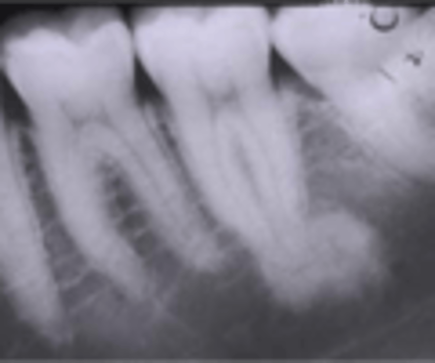 <p>this condition is related to a low-grade inflammatory reaction. what condition does this describe?</p><p>a. periodical cement dysplasia</p><p>b. concrescence</p><p>c. focal sclerosis osteitis</p><p>d. cementoma</p>