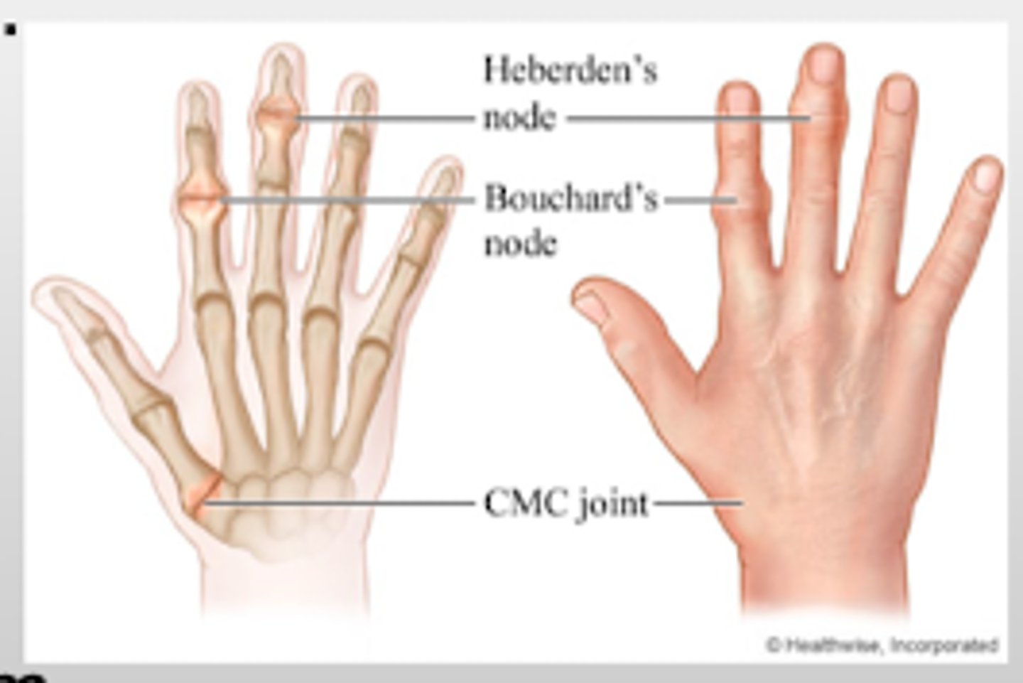 <p>PIP joints (OA)</p>