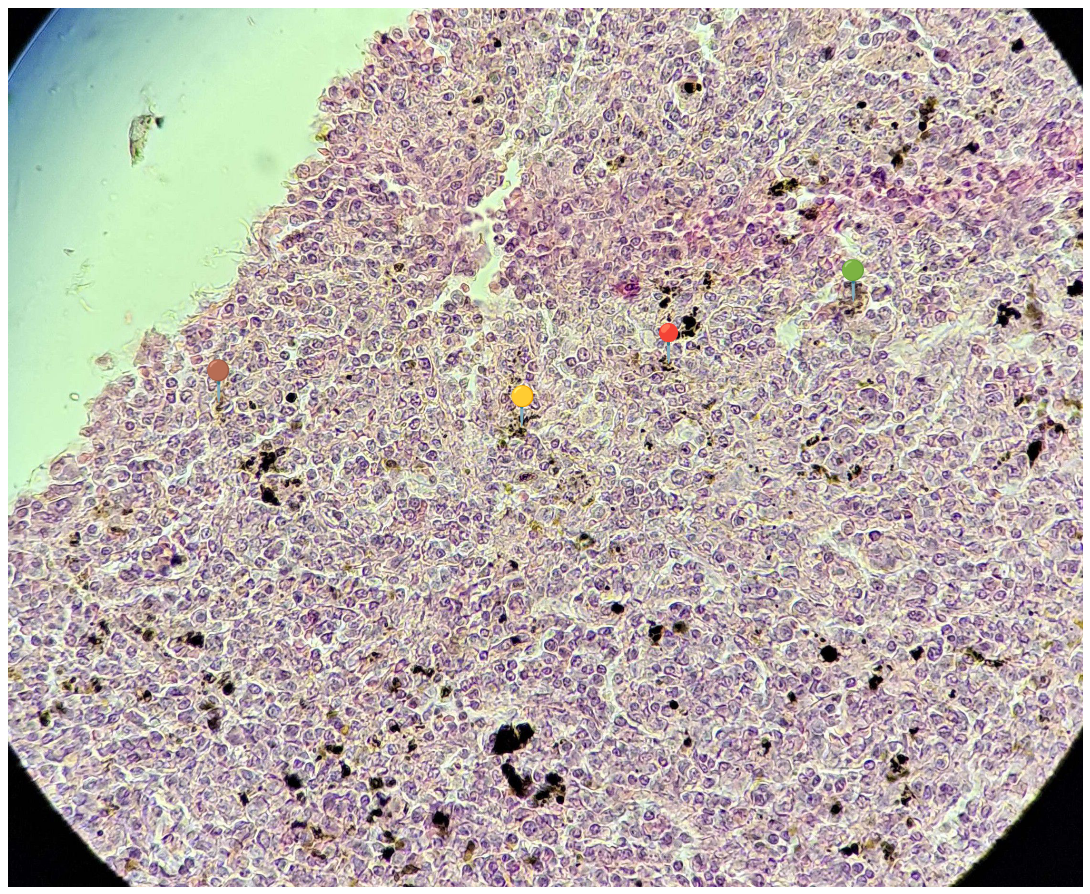 <p><strong><em>Plasmodium sp.</em></strong></p><p>(śledziona - malaria melanemia)</p><p></p><p></p><p><strong>Cechy charakterystyczne</strong>:</p><p></p><ul><li><p><span data-name="red_circle" data-type="emoji">🔴</span><span data-name="yellow_circle" data-type="emoji">🟡</span><span data-name="green_circle" data-type="emoji">🟢</span><span>️</span><span data-name="brown_circle" data-type="emoji">🟤</span><span> - złogi hemosyderyny.</span></p></li></ul><p></p><p></p><p><strong>Parazytoza</strong>: <em>Malaria</em></p>