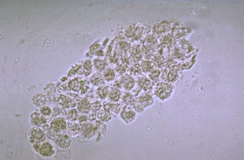 <p>Cast with leukocytes embedded in the matrix.</p><p>Associated with inflammation, infection, and renal tubular disease. </p>