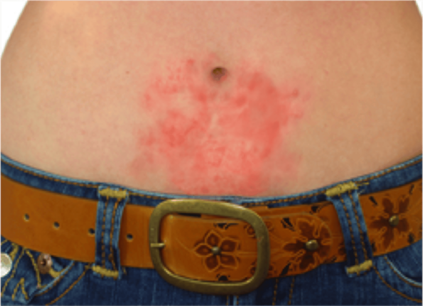 <p>caused by occupational disorders from ingredients in cosmetics &amp; chemical solutions</p>